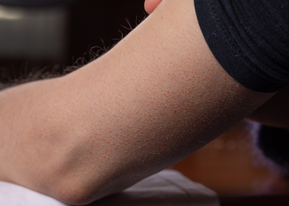 keratosis pilaris