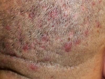 Folliculitis