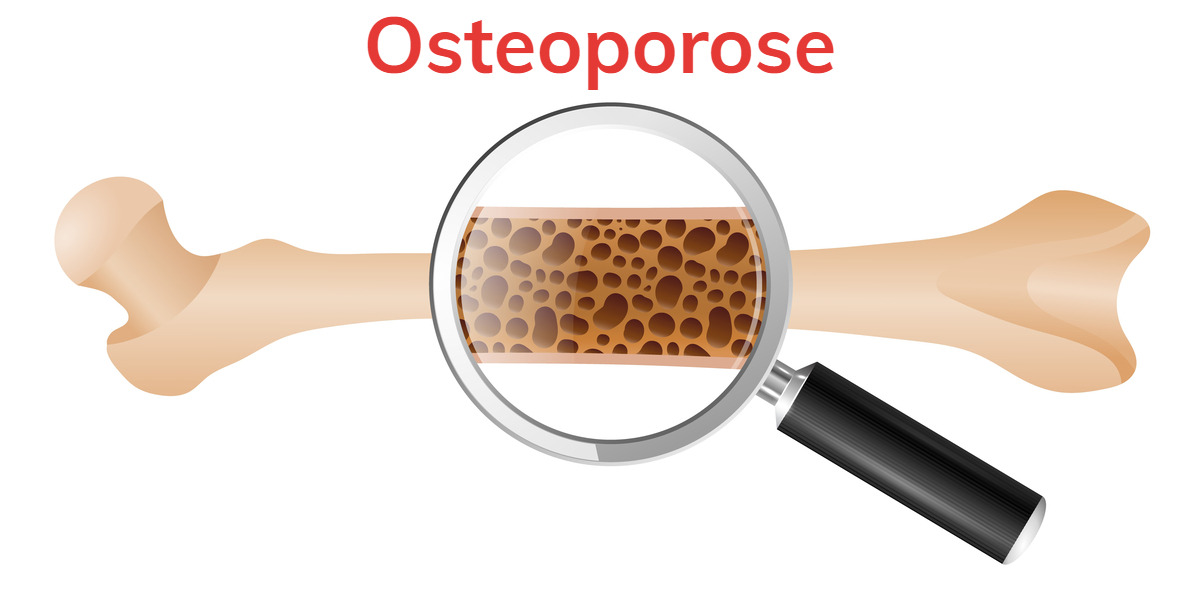 Poreus bot bij osteoporose