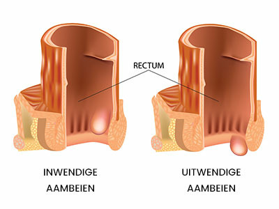 inwendige en uitwendige aambeien